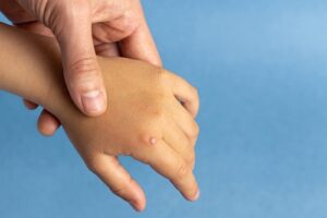 If treating a child with warts, dilute 10 drops of Lemon and 5 drops and Cypress in 2 teaspoons cider vinegar.